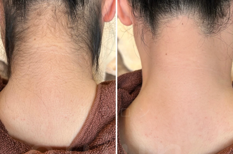 before - 3